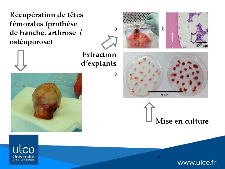 Récupération de têtes fémorales (prothèse de hanche, arthrose / ostéoporose) Extraction d’explants Mise en