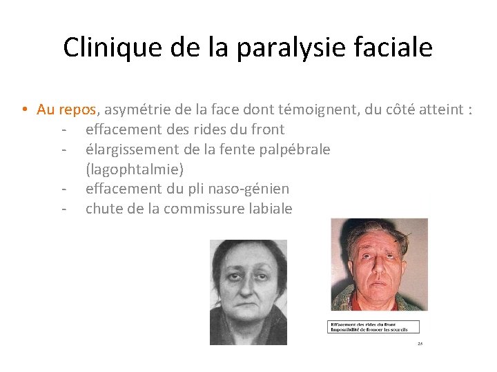 Clinique de la paralysie faciale • Au repos, asymétrie de la face dont témoignent,