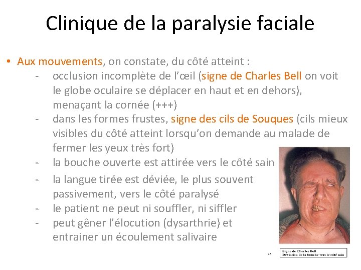 Clinique de la paralysie faciale • Aux mouvements, on constate, du côté atteint :
