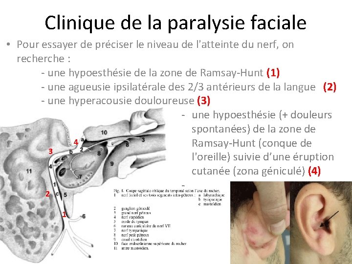 Clinique de la paralysie faciale • Pour essayer de préciser le niveau de l'atteinte