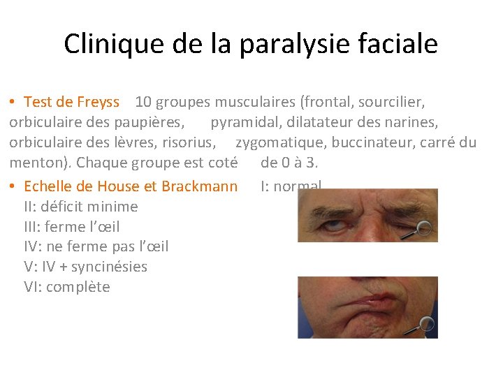 Clinique de la paralysie faciale • Test de Freyss  10 groupes musculaires (frontal, sourcilier,