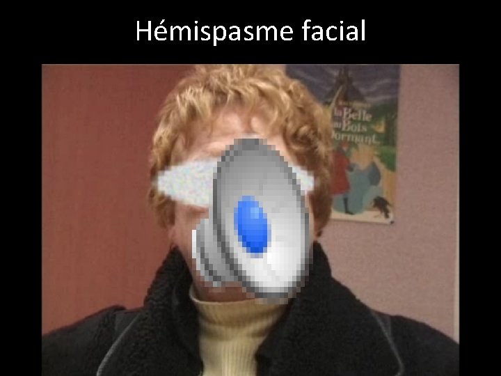 Hémispasme facial 