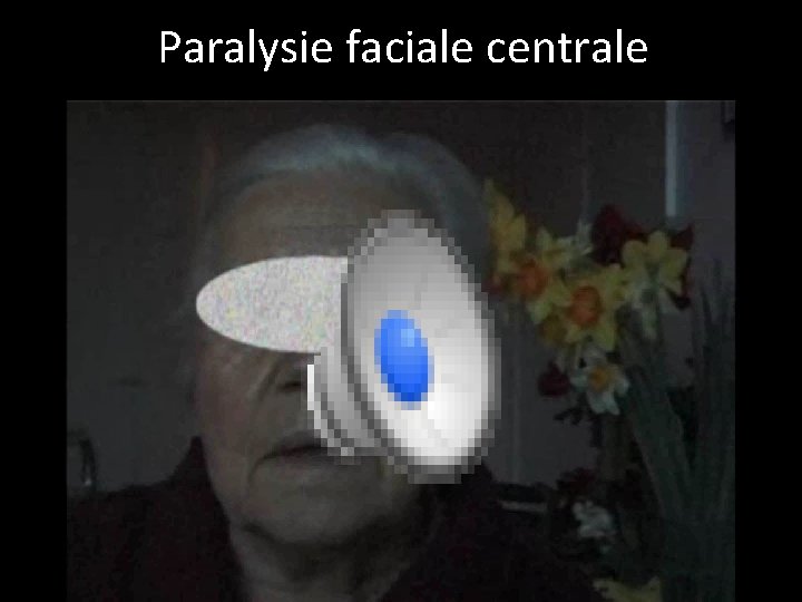 Paralysie faciale centrale 