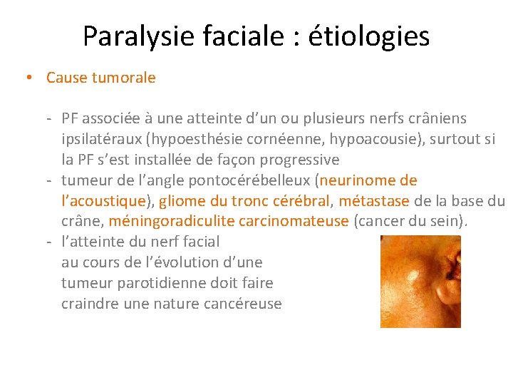 Paralysie faciale : étiologies • Cause tumorale - PF associée à une atteinte d’un