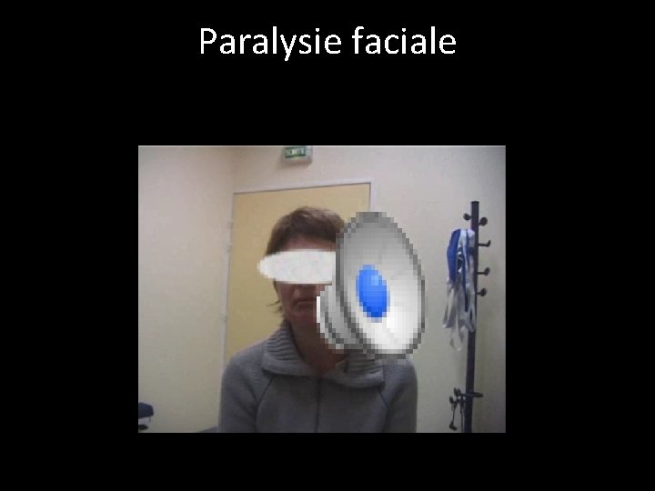 Paralysie faciale 