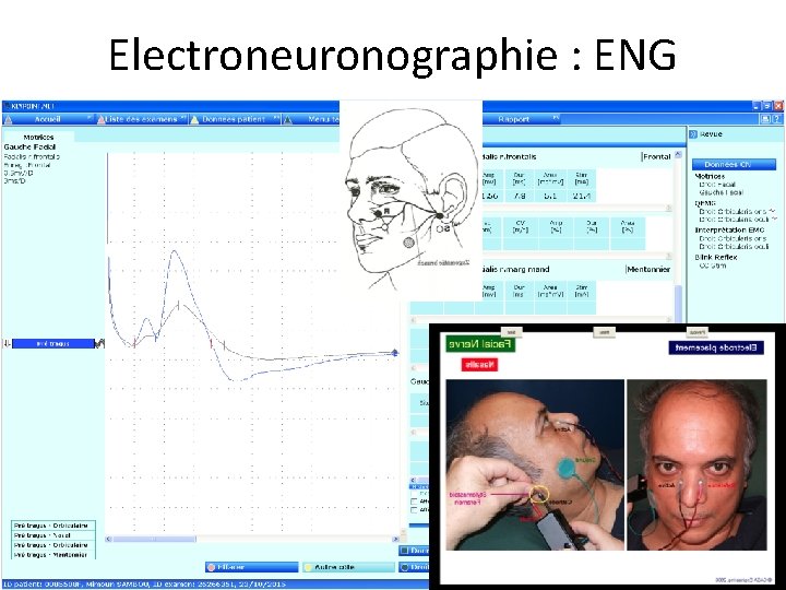Electroneuronographie : ENG 