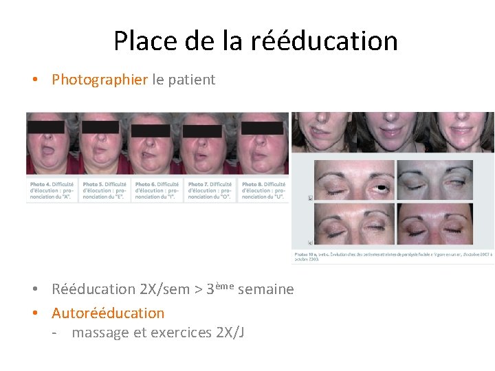 Place de la rééducation • Photographier le patient • Rééducation 2 X/sem > 3ème