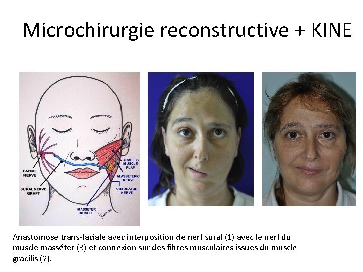 Microchirurgie reconstructive + KINE Anastomose trans-faciale avec interposition de nerf sural (1) avec le