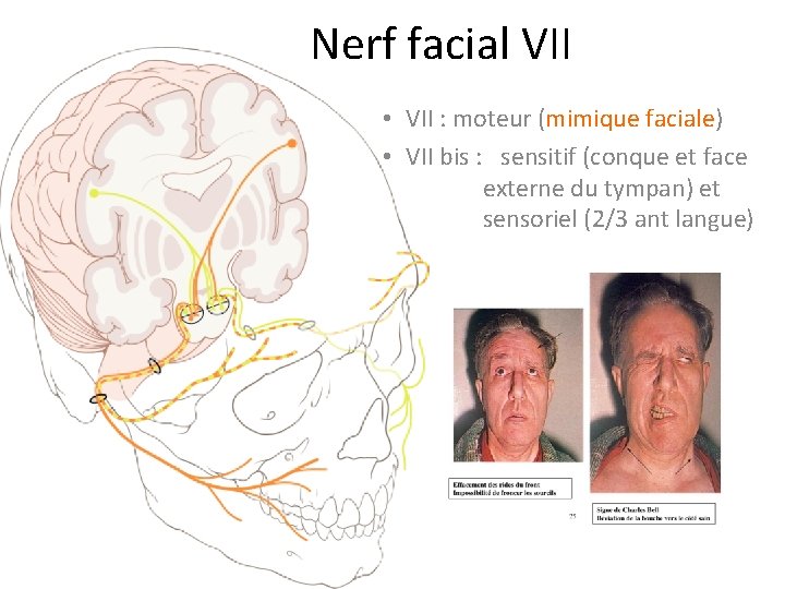 Nerf facial VII • VII : moteur (mimique faciale) • VII bis : sensitif