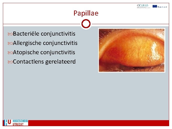 Papillae Bacteriële conjunctivitis Allergische conjunctivitis Atopische conjunctivitis Contactlens gerelateerd 