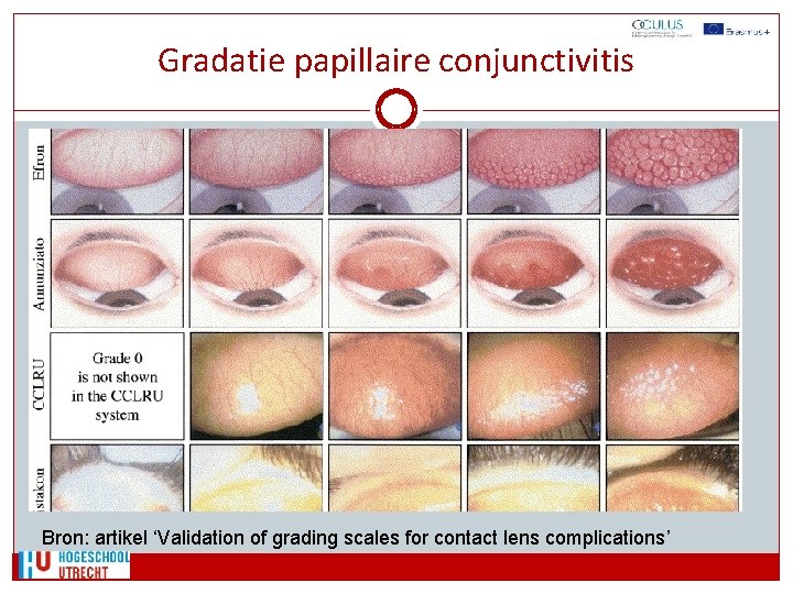 Gradatie papillaire conjunctivitis Bron: artikel ‘Validation of grading scales for contact lens complications’ 