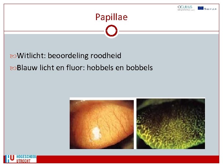 Papillae Witlicht: beoordeling roodheid Blauw licht en fluor: hobbels en bobbels 