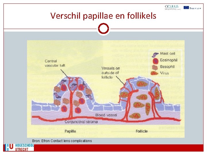 Verschil papillae en follikels Bron: Efron Contact lens complications 