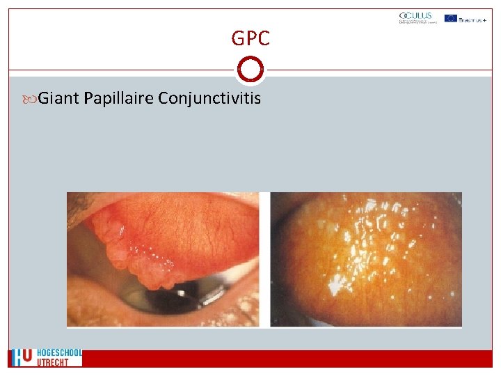 GPC Giant Papillaire Conjunctivitis 