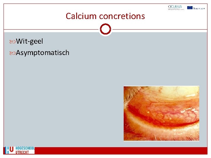 Calcium concretions Wit-geel Asymptomatisch 