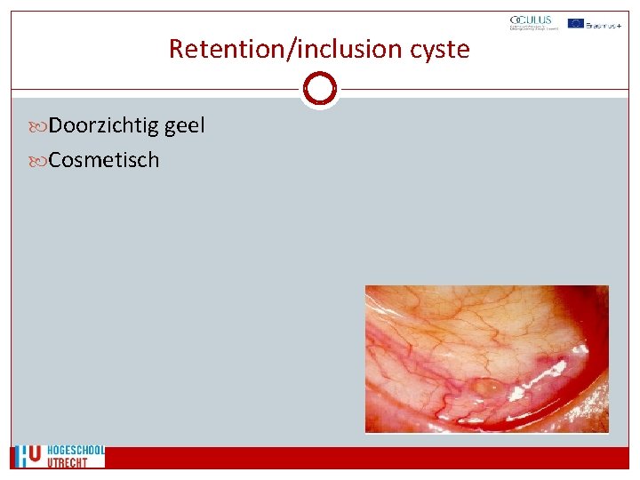 Retention/inclusion cyste Doorzichtig geel Cosmetisch 