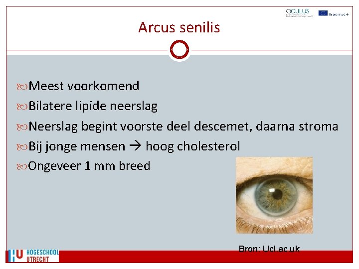 Arcus senilis Meest voorkomend Bilatere lipide neerslag Neerslag begint voorste deel descemet, daarna stroma