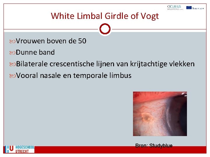 White Limbal Girdle of Vogt Vrouwen boven de 50 Dunne band Bilaterale crescentische lijnen