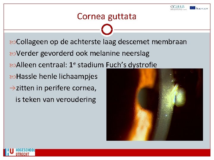 Cornea guttata Collageen op de achterste laag descemet membraan Verder gevorderd ook melanine neerslag