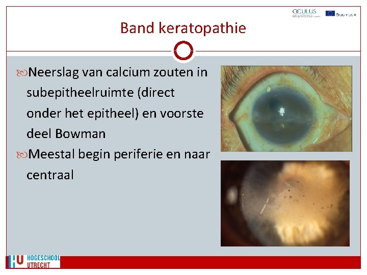 Band keratopathie Neerslag van calcium zouten in subepitheelruimte (direct onder het epitheel) en voorste