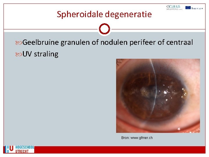 Spheroidale degeneratie Geelbruine granulen of nodulen perifeer of centraal UV straling Bron: www. gfmer.