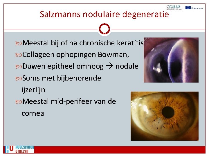 Salzmanns nodulaire degeneratie Meestal bij of na chronische keratitis Collageen ophopingen Bowman, Duwen epitheel