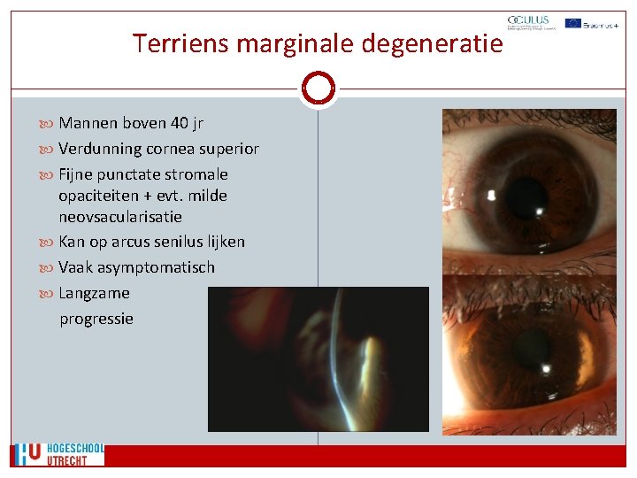 Terriens marginale degeneratie Mannen boven 40 jr Verdunning cornea superior Fijne punctate stromale opaciteiten