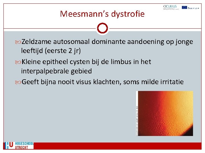 Meesmann’s dystrofie Zeldzame autosomaal dominante aandoening op jonge leeftijd (eerste 2 jr) Kleine epitheel