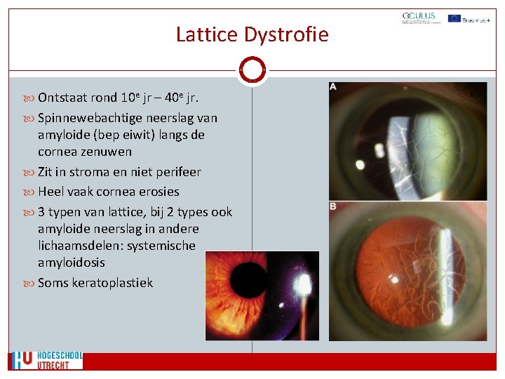 Lattice Dystrofie Ontstaat rond 10 e jr – 40 e jr. Spinnewebachtige neerslag van