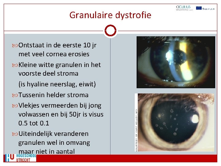 Granulaire dystrofie Ontstaat in de eerste 10 jr met veel cornea erosies Kleine witte