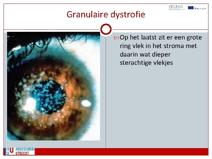 Granulaire dystrofie Op het laatst zit er een grote ring vlek in het stroma