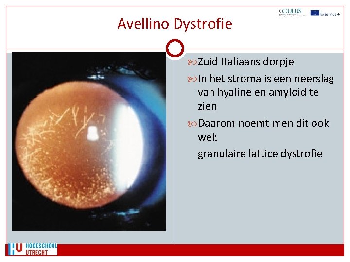 Avellino Dystrofie Zuid Italiaans dorpje In het stroma is een neerslag van hyaline en