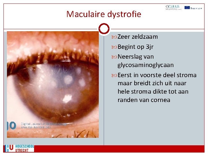 Maculaire dystrofie Zeer zeldzaam Begint op 3 jr Neerslag van glycosaminoglycaan Eerst in voorste