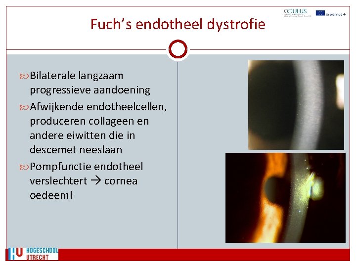 Fuch’s endotheel dystrofie Bilaterale langzaam progressieve aandoening Afwijkende endotheelcellen, produceren collageen en andere eiwitten