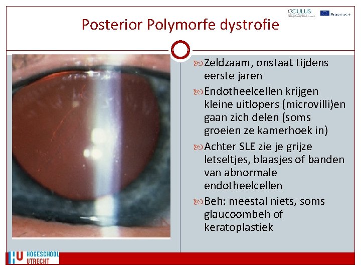 Posterior Polymorfe dystrofie Zeldzaam, onstaat tijdens eerste jaren Endotheelcellen krijgen kleine uitlopers (microvilli)en gaan