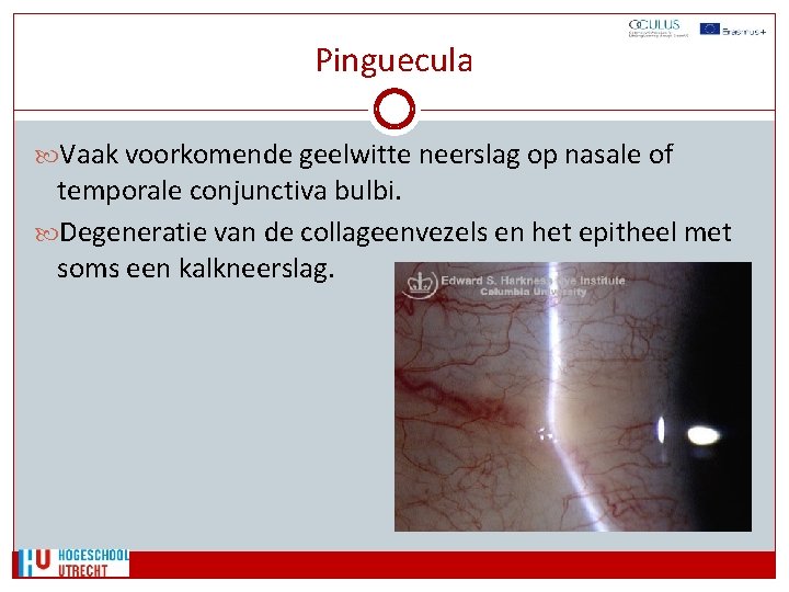 Pinguecula Vaak voorkomende geelwitte neerslag op nasale of temporale conjunctiva bulbi. Degeneratie van de