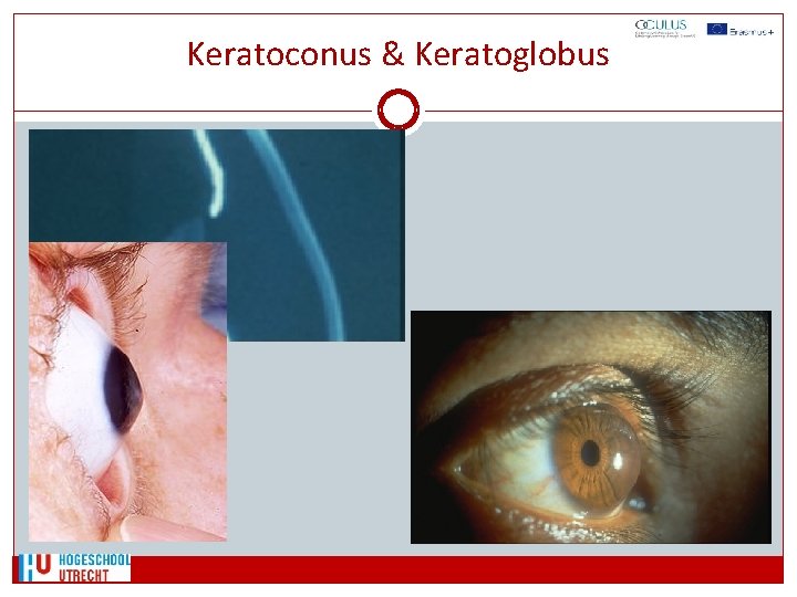Keratoconus & Keratoglobus 