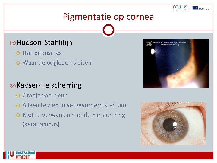 Pigmentatie op cornea Hudson-Stahlilijn IJzerdeposities Waar de oogleden sluiten Kayser-fleischerring Oranje van kleur Alleen