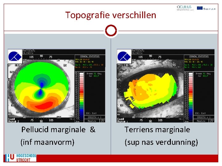 Topografie verschillen Pellucid marginale & (inf maanvorm) Terriens marginale (sup nas verdunning) 