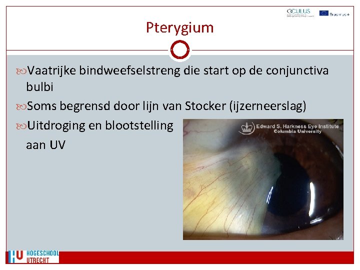 Pterygium Vaatrijke bindweefselstreng die start op de conjunctiva bulbi Soms begrensd door lijn van