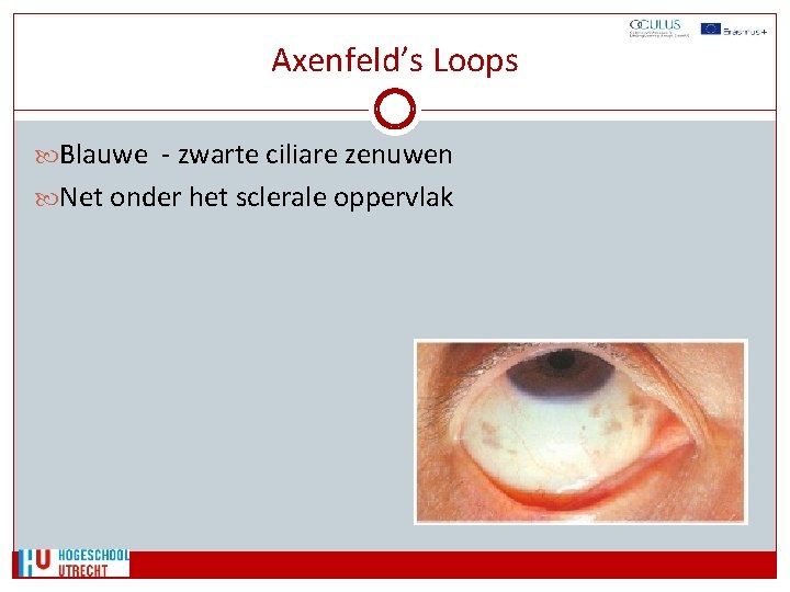 Axenfeld’s Loops Blauwe - zwarte ciliare zenuwen Net onder het sclerale oppervlak 