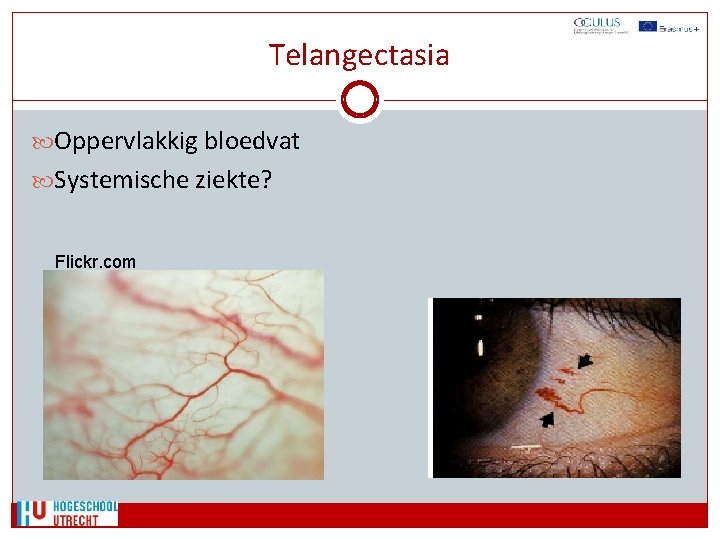 Telangectasia Oppervlakkig bloedvat Systemische ziekte? Flickr. com 