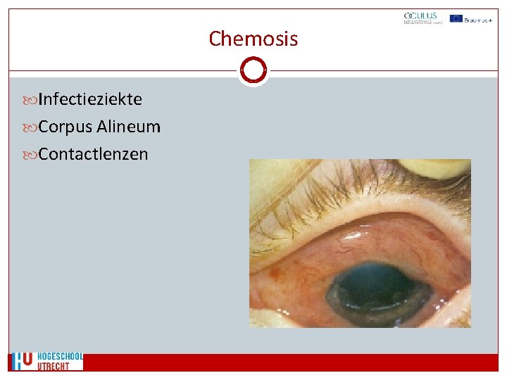 Chemosis Infectieziekte Corpus Alineum Contactlenzen 
