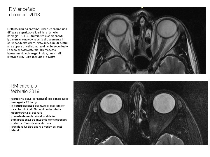 RM encefalo dicembre 2018 Retti inferiori da entrambi i lati presentano una diffusa e