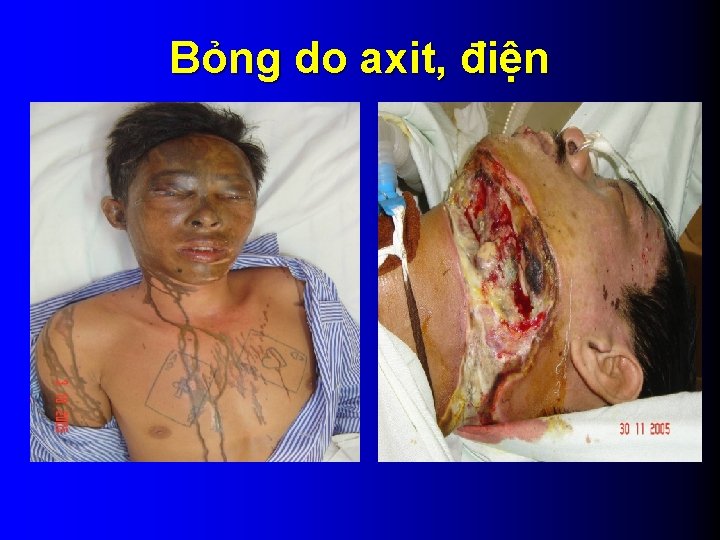 Bỏng do axit, điện 