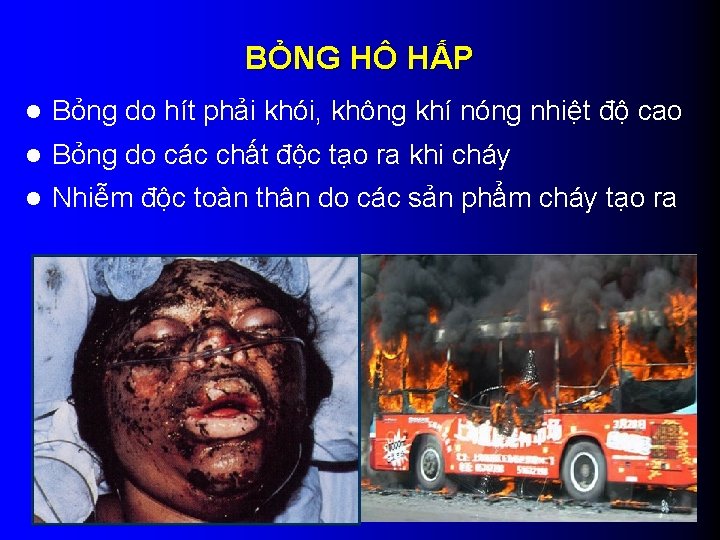 BỎNG HÔ HẤP l Bỏng do hít phải khói, không khí nóng nhiệt độ