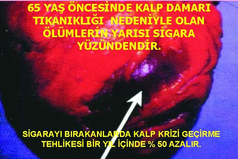 65 YAŞ ÖNCESİNDE KALP DAMARI TIKANIKLIĞI NEDENİYLE OLAN ÖLÜMLERİN YARISI SİGARA YÜZÜNDENDİR. SİGARAYI BIRAKANLARDA