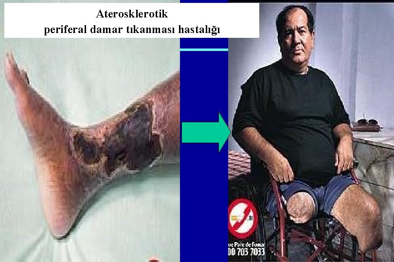 Aterosklerotik periferal damar tıkanması hastalığı 