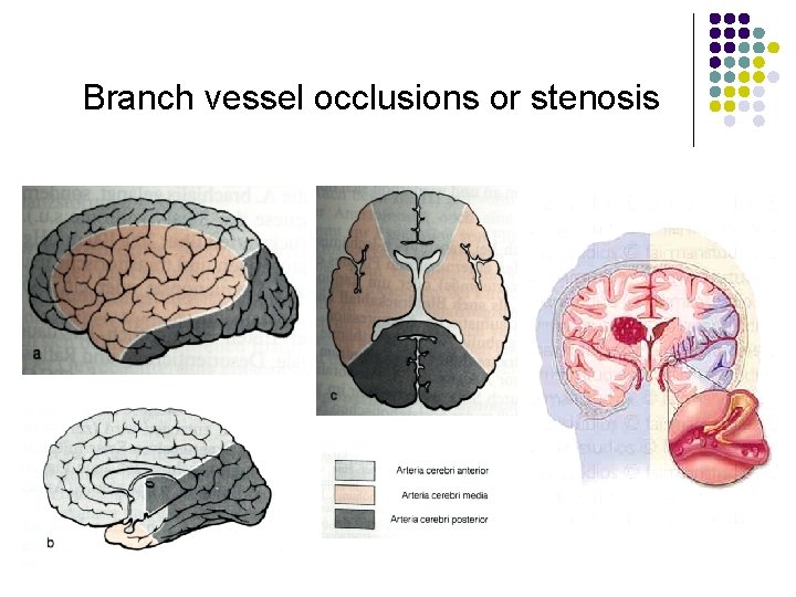 Branch vessel occlusions or stenosis 