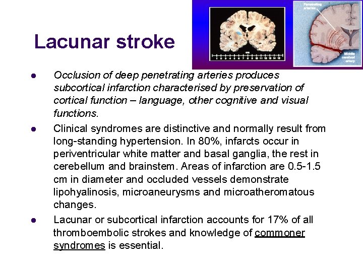 Lacunar stroke l l l Occlusion of deep penetrating arteries produces subcortical infarction characterised